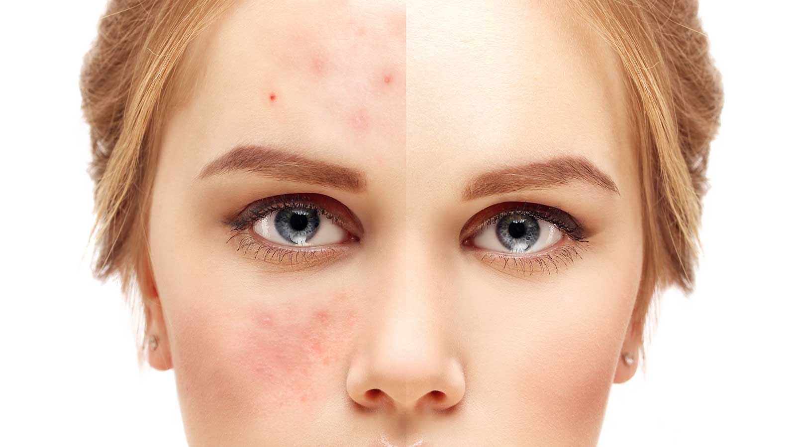 Can Oily Skin Change to Dry Skin?