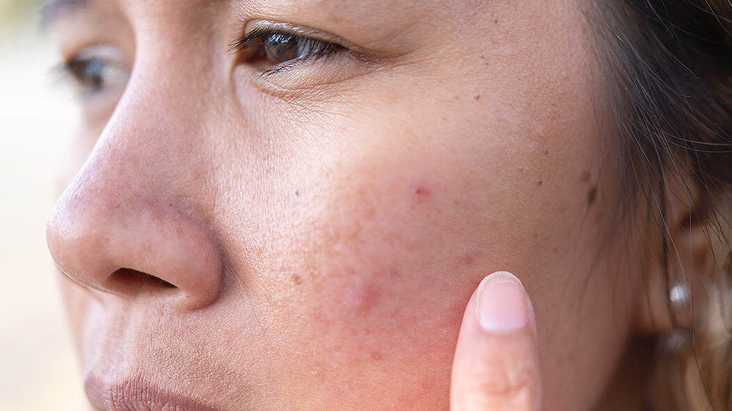 Does Oily Face Cause Pimples? The Truth Behind the Shine