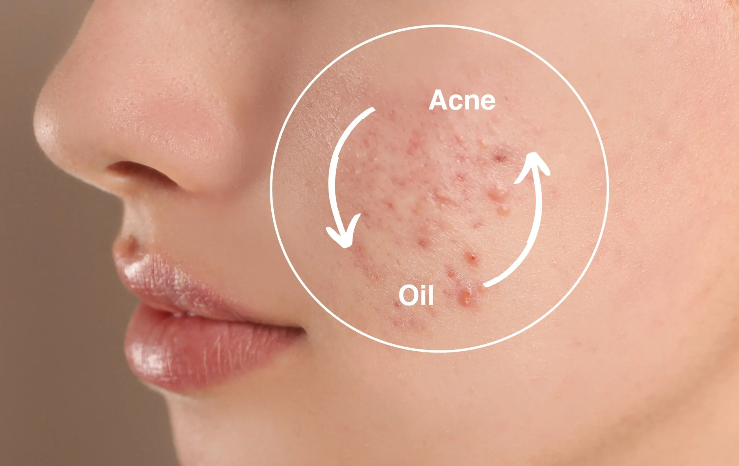 Does Oily Skin Cause Acne?