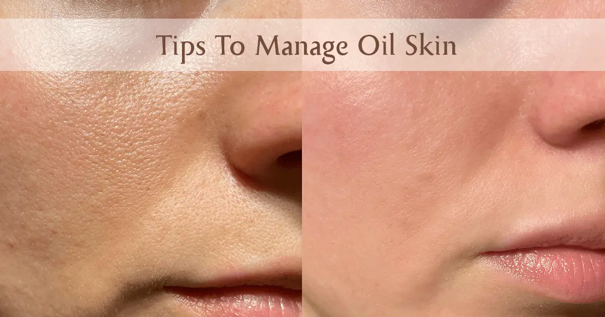 How to Reduce Oily Skin Naturally